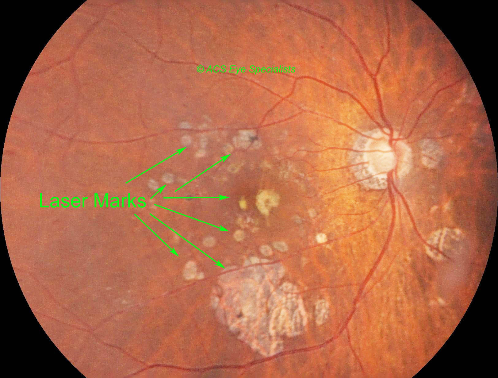 Diabetic Retinopathy ACS Eye Specialists check up